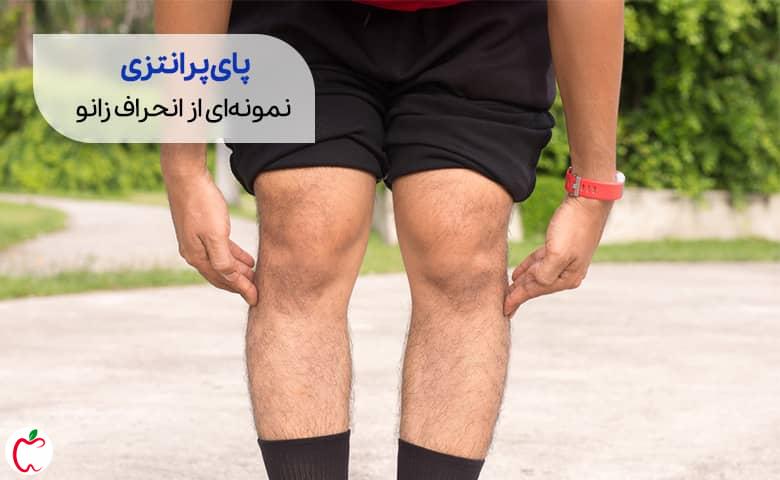 فردی با پای پرانتزی | علت درد زانو سیوطب