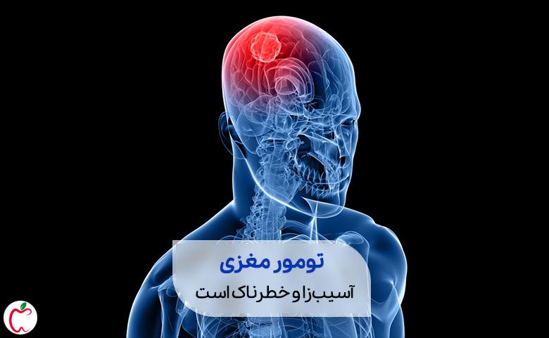 تومور مغزی که ایجادکننده سردرد تومور مغزی است|سیوطب