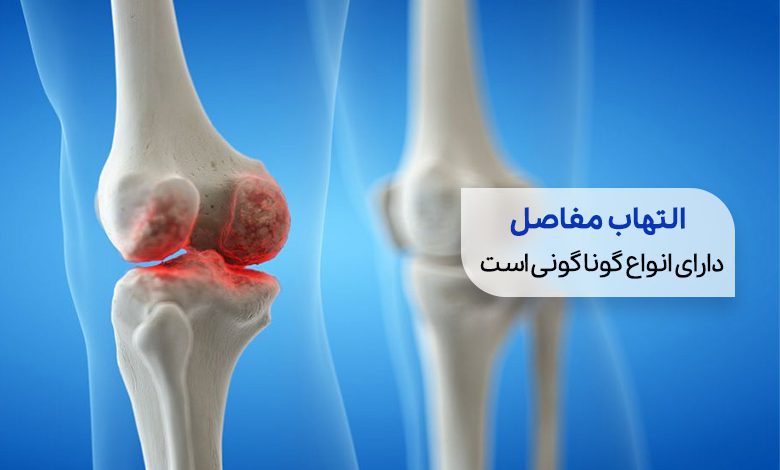 یک مفصل دارای بیماری التهاب مفاصل| سیوطب