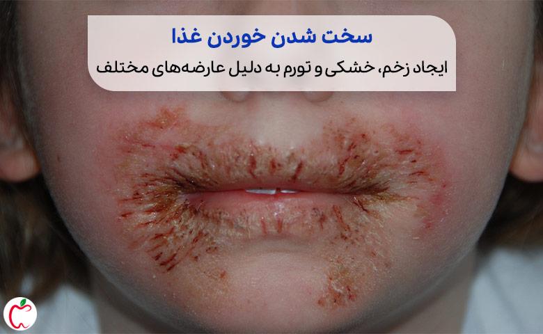 علت خارش دهان و بروز خشکی و قرمزی در اطراف دهان به دلیل حساسیت یا عفونت‌های قارچی و ویروسی|سیو طب