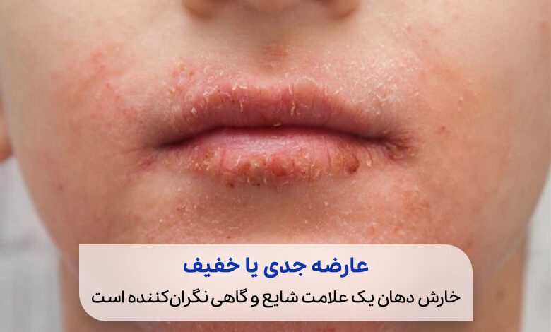 ایجاد حساسیت پوستی و خارش در اطراف دهان که علت خارش دهان و پوست است|سیوطب