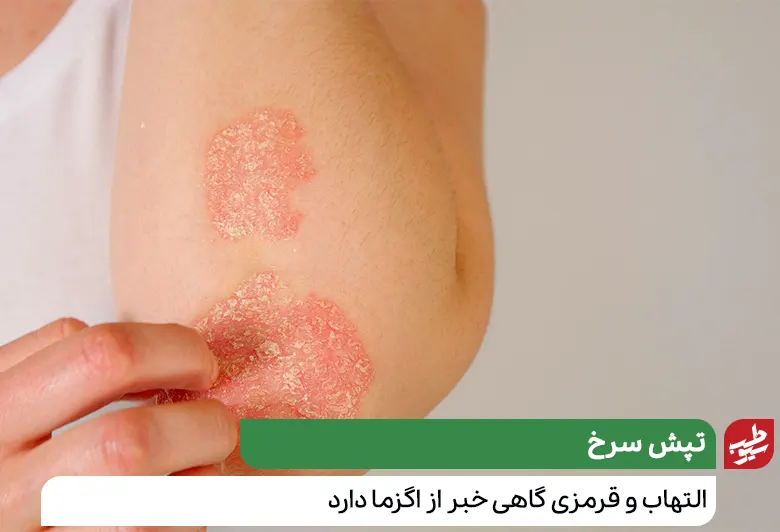 درمان خشکی پوست و نشانه‌های بیماری اگزما|سیوطب