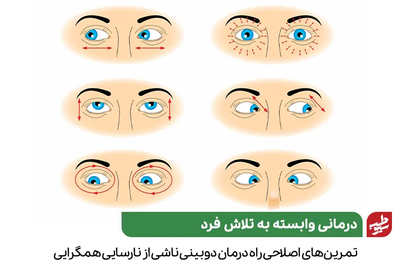 تمرین‌های اصلاحی راهی برای درمان دوبینی چشم هستند|سیوطب