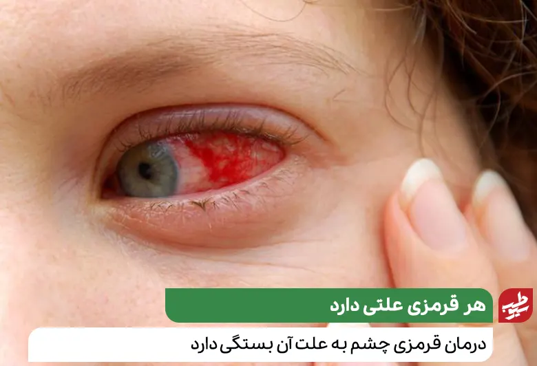 درمان قرمزی چشم به علت ایجاد کننده آن بستگی دارد|سیوطب