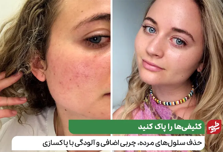 تفاوت پوست صورت قبل و بعد از پاکسازی صورت|سیوطب