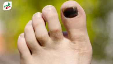 درمان سیاه شدن ناخن پا به علت آن بستگی دارد|سیوطب