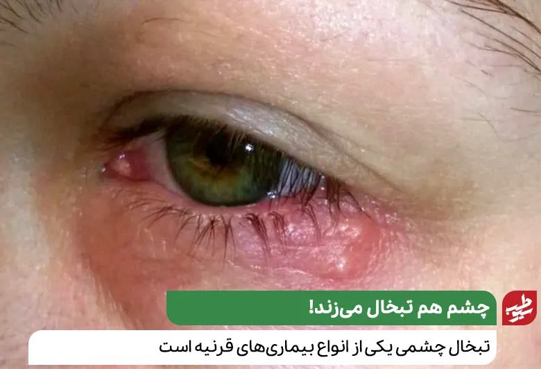 تبخال چشمی یکی از انواع بیماری های قرنیه است|سیوطب