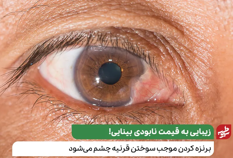 آسیب چشم فوتوکراتیت از عوارض برنزه کرده بدن|سیوطب