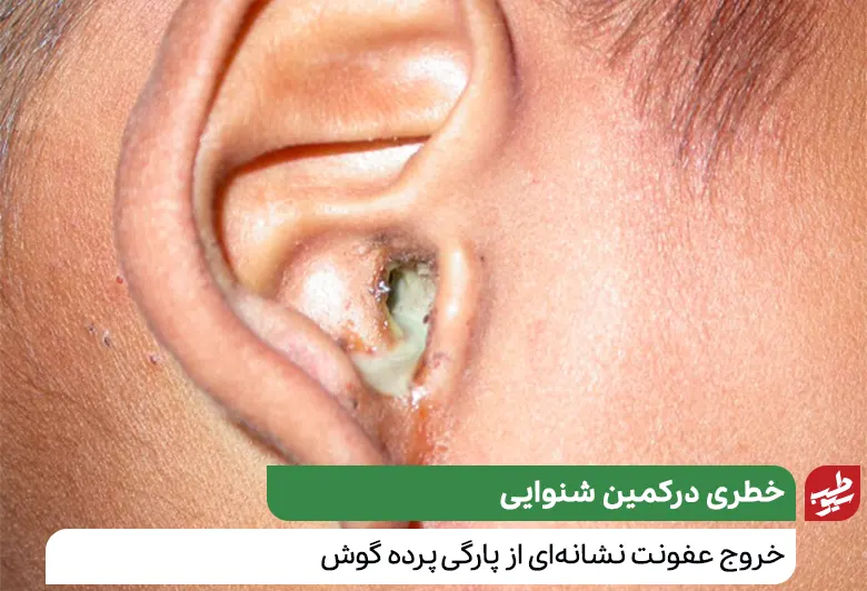 گوشی که عفونت از آن بیرون زده است و نیاز به درمان عفونت گوش دارد|سیوطب