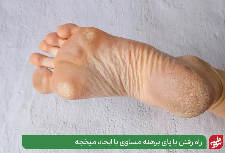 پاهای برهنه‌ای که بر اثر پیاده روی زیاد دچار پینه و میخچه شده است|سیوطب