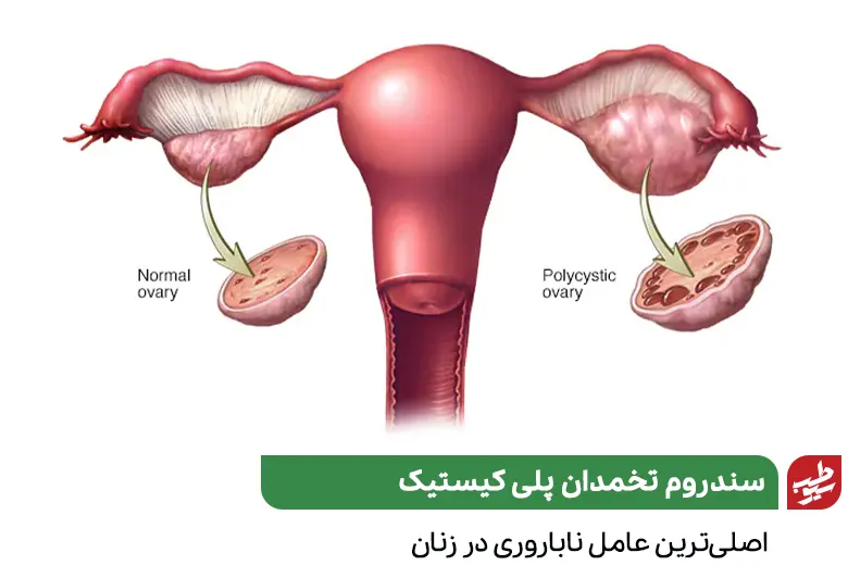 سندروم تخمدان پلی کیستیک که نشان‌دهنده عدم تقویت در تخمدان و بارداری سریع است|سیوطب