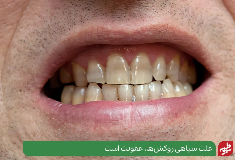 علت عفونت دندان روکش شده نصب نادرست روکش‌ها است|سیوطب