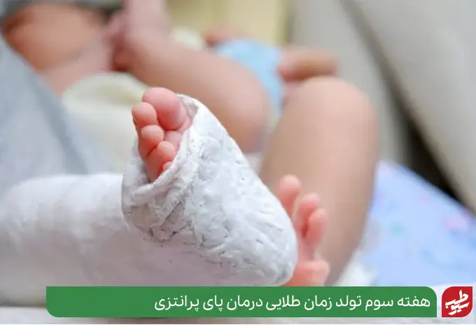 درمان پای پرانتزی نوزاد که گچ گرفته شده است|سیوطب