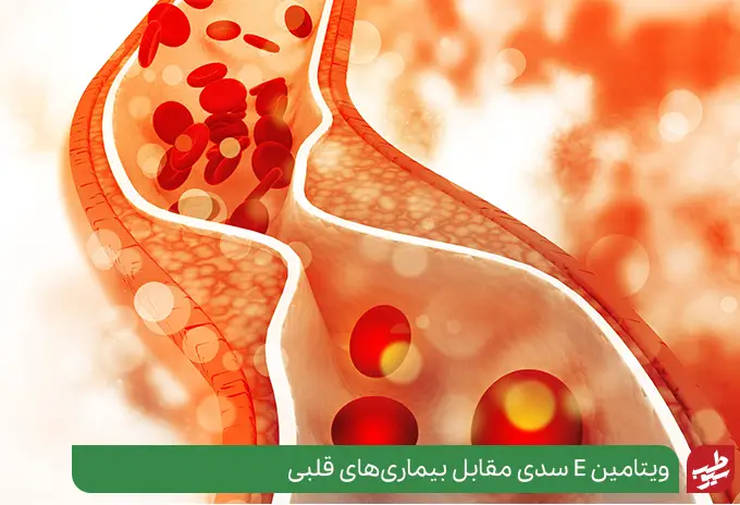 تاثیر خواص ویتامین ای برای شریان‌های قلبی حاوی کلسترول بد (LDL)|سیوطب