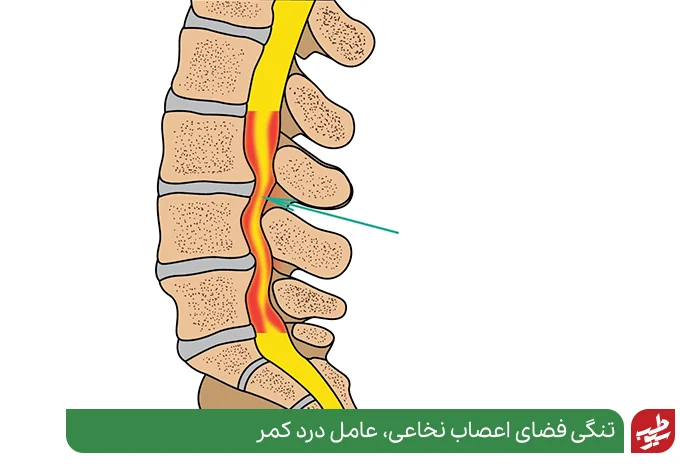 درد پهلو سمت راست ممکن است ناشی از تنگی کانال نخاعی کمر باشد|سیوطب