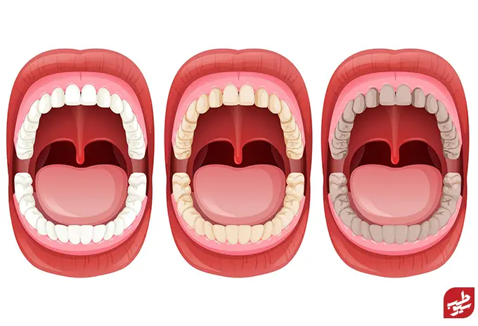 عوامل ایجاد لکه های سياه دندان