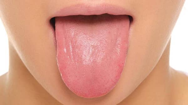 شوری دهان | عوارض و روش هاي درماني شوري دهان