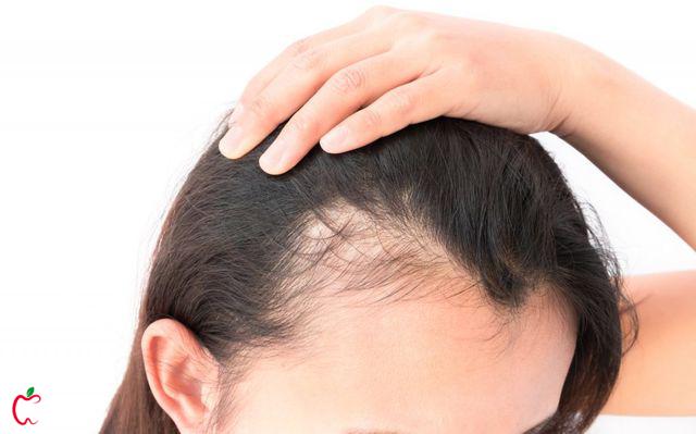 زنی با موهای مشکی دچار ریزش مو | سیوطب