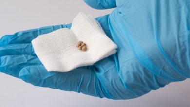 سنگ کیسه صفرا در دست پزشک | سیوطب | درمان سنگ کیسه صفرا