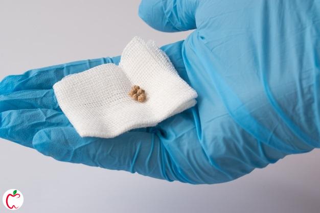 سنگ کیسه صفرا در دست پزشک | سیوطب | درمان سنگ کیسه صفرا