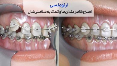 نمای گرافیکی از دندان ها قبل و بعد از ارتودنسی سیوطب