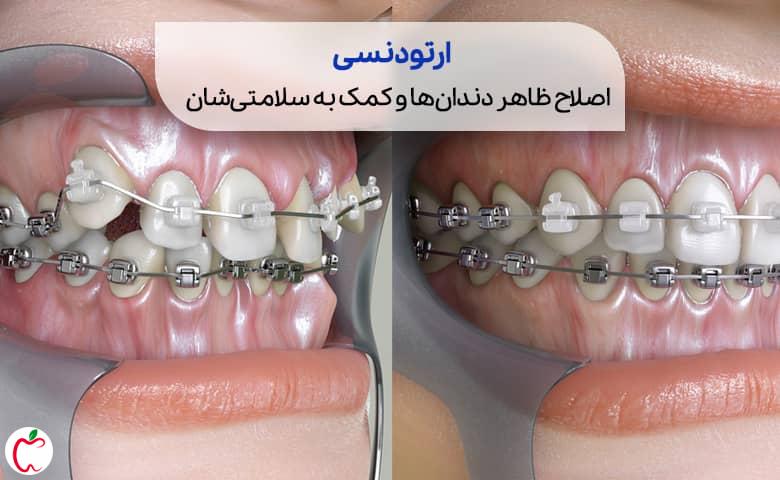 نمای گرافیکی از دندان ها قبل و بعد از ارتودنسی سیوطب