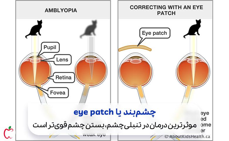 وکتور از نحوه عملکرد چشم‌بند در بهبود تنبلی چشم| سیوطب