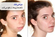 تصویر قبل و بعد از جراحی فک| سیوطب