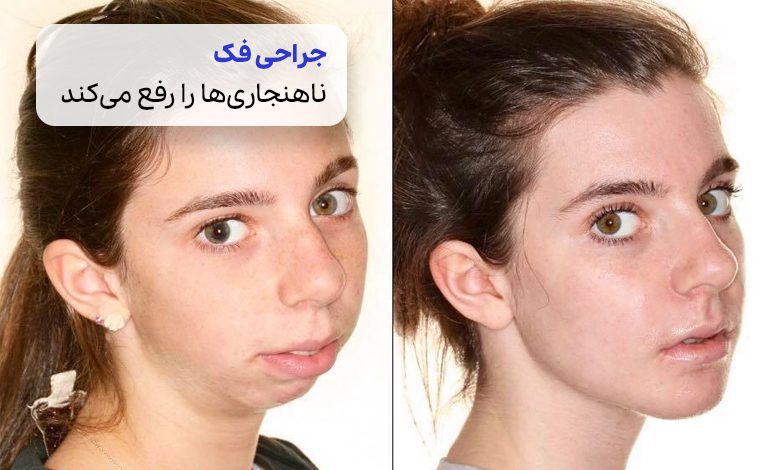 تصویر قبل و بعد از جراحی فک| سیوطب