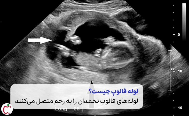تصویری سونوگرافی جنین در بارداری خارج از رحم |سیوطب