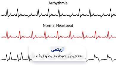 دو تصویر از نمودار ضربان قلب سالم و ضربان قلب فرد مبتلا به آریتمی قلبی|سیوطب