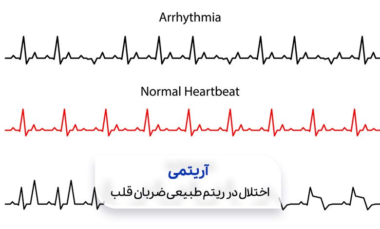 دو تصویر از نمودار ضربان قلب سالم و ضربان قلب فرد مبتلا به آریتمی قلبی|سیوطب