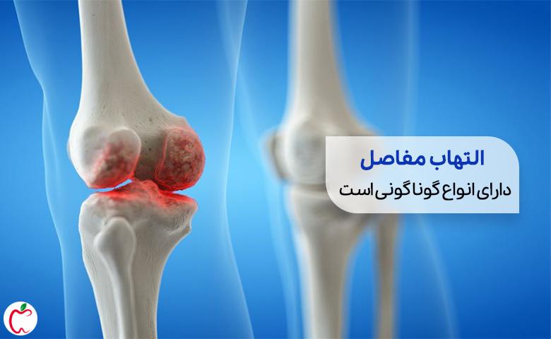 یک مفصل دارای بیماری التهاب مفاصل| سیوطب