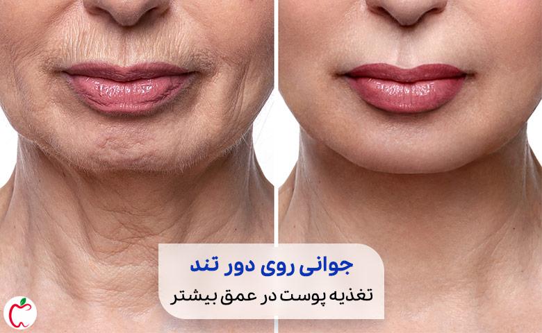تصویر قبل و بعد از مزوتراپی روی پوست صورت زنی سالمند| سیوطب
