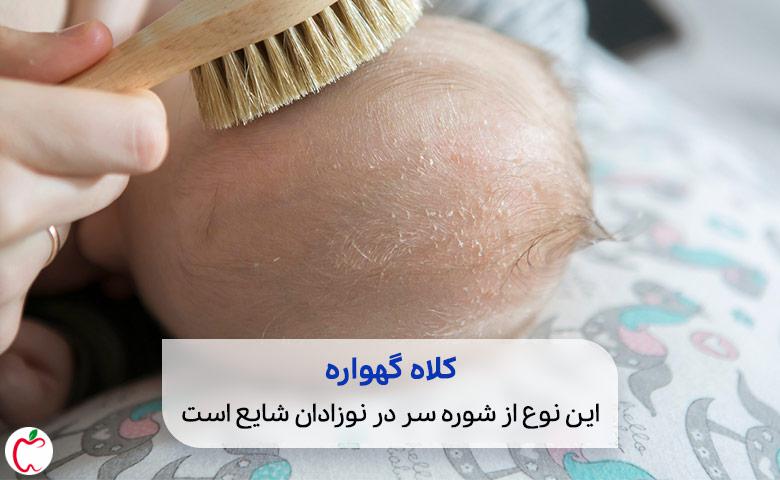 علائم شوره سر از نوع کلاه گهواره (cradle cap) در یک نوزاد| سیوطب