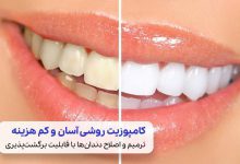 کامپوزیت دندان راهی برای زیبایی و ترمیم دندان‌ها| سیوطب