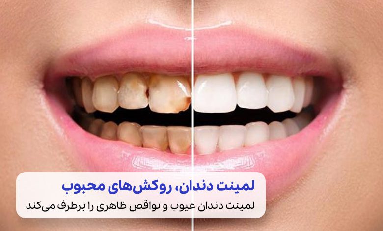 عکس قبل و بعد از لمینت دندان|سیوطب
