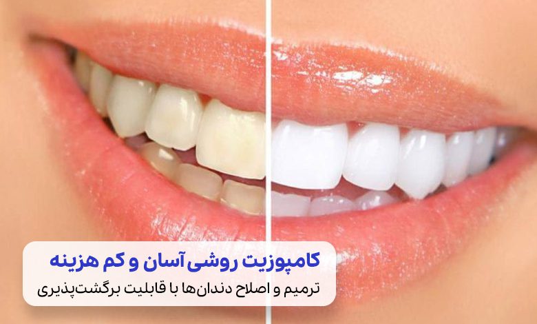 کامپوزیت دندان راهی برای زیبایی و ترمیم دندان‌ها| سیوطب