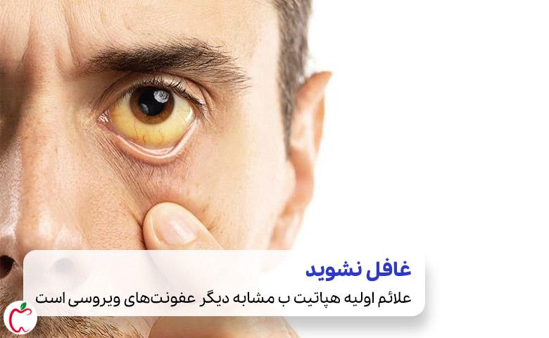 زردی چشم و پوست که از علائم هپاتیت ب هستند| سیوطب