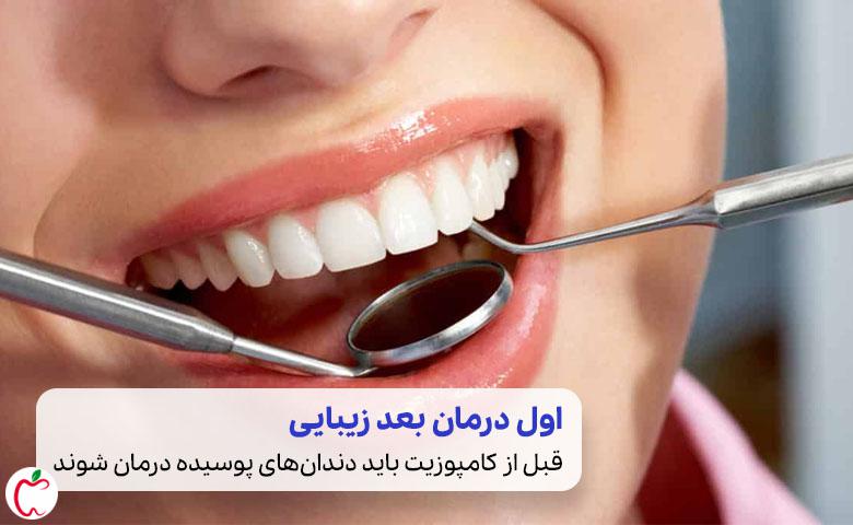 اول درمان دندان‌های پوسیده بعد کامپوزیت دندان| سیوطب