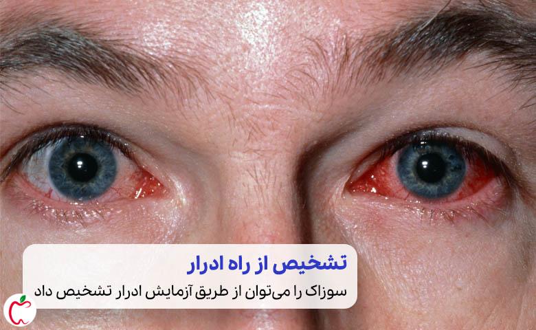 زخم در چشم و نیاز به درمان سوزاک|سیوطب