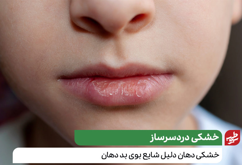 علت بوی بد دهان کودکان به دلیل بزرگی لوزه‌ها|سیوطب