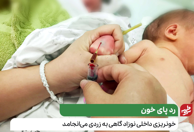 تصویر نوزادی که با شلنگ‌های سرمی در حال خون دادن است|سیوطب