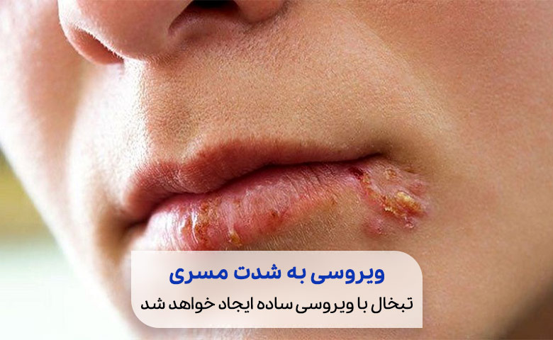 درمان خارش دهان و لب به دلیل تبخال ایجاد شده در این قسمت‌ها|سیو طب