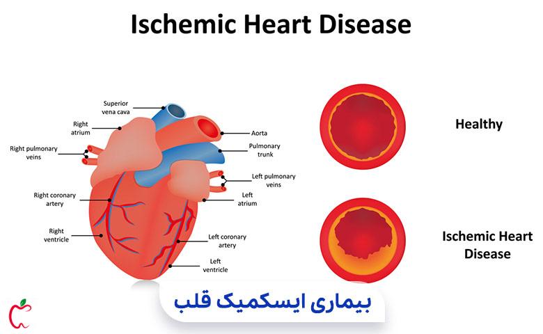 بیماری ایسکمیک قلب در بیماری‌‌ های شایع سالمندان|سیوطب