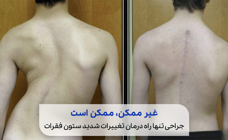 ورزش برای اسکولیوز شدید مناسب نیست|سیوطب