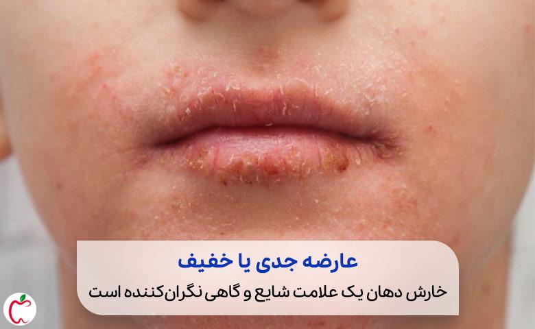 ایجاد حساسیت پوستی و خارش در اطراف دهان که علت خارش دهان و پوست است|سیوطب