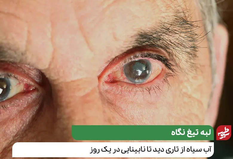 درمان تاری دید در چشمی که داخل آن به خاطر آب سیاه تغییر رنگ داده است|سیوطب