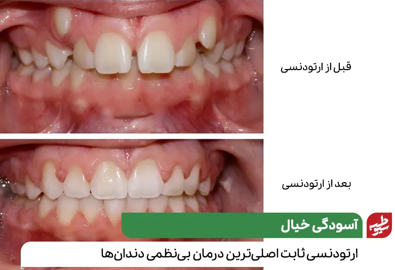 ارتودنسی ثابت و تاثیر آن بر دندان‌ها قبل و بعد از ارتودنسی|سیوطب