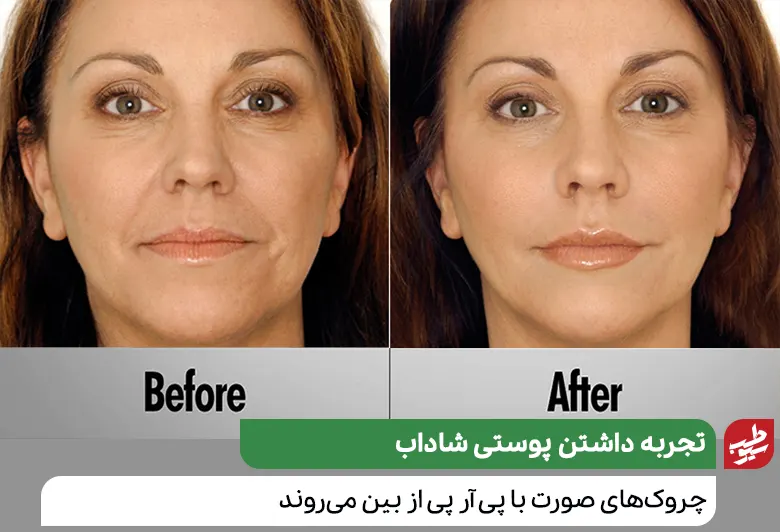 چهره‌ خانمی قبل و بعد از پی آر پی صورت|سیوطب